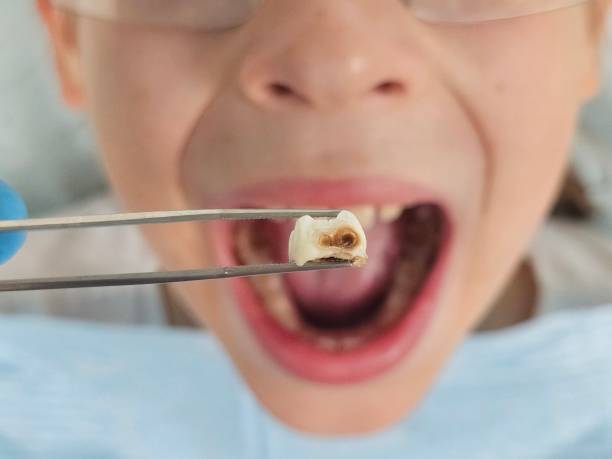 Best Emergency Wisdom Teeth Removal in Pawhuska, OK